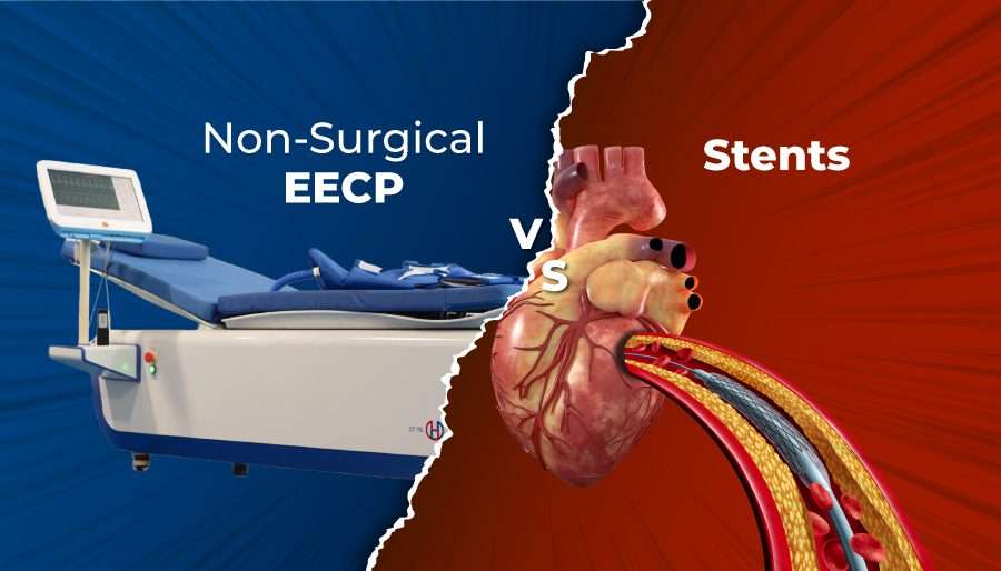 Non-Surgical-EECP-vs.-Stents